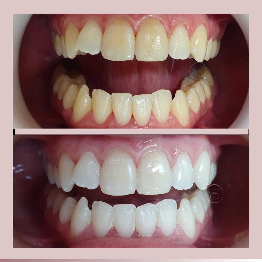 CREST 3D WHITESTRIPS™ BRIGHT WHITE
