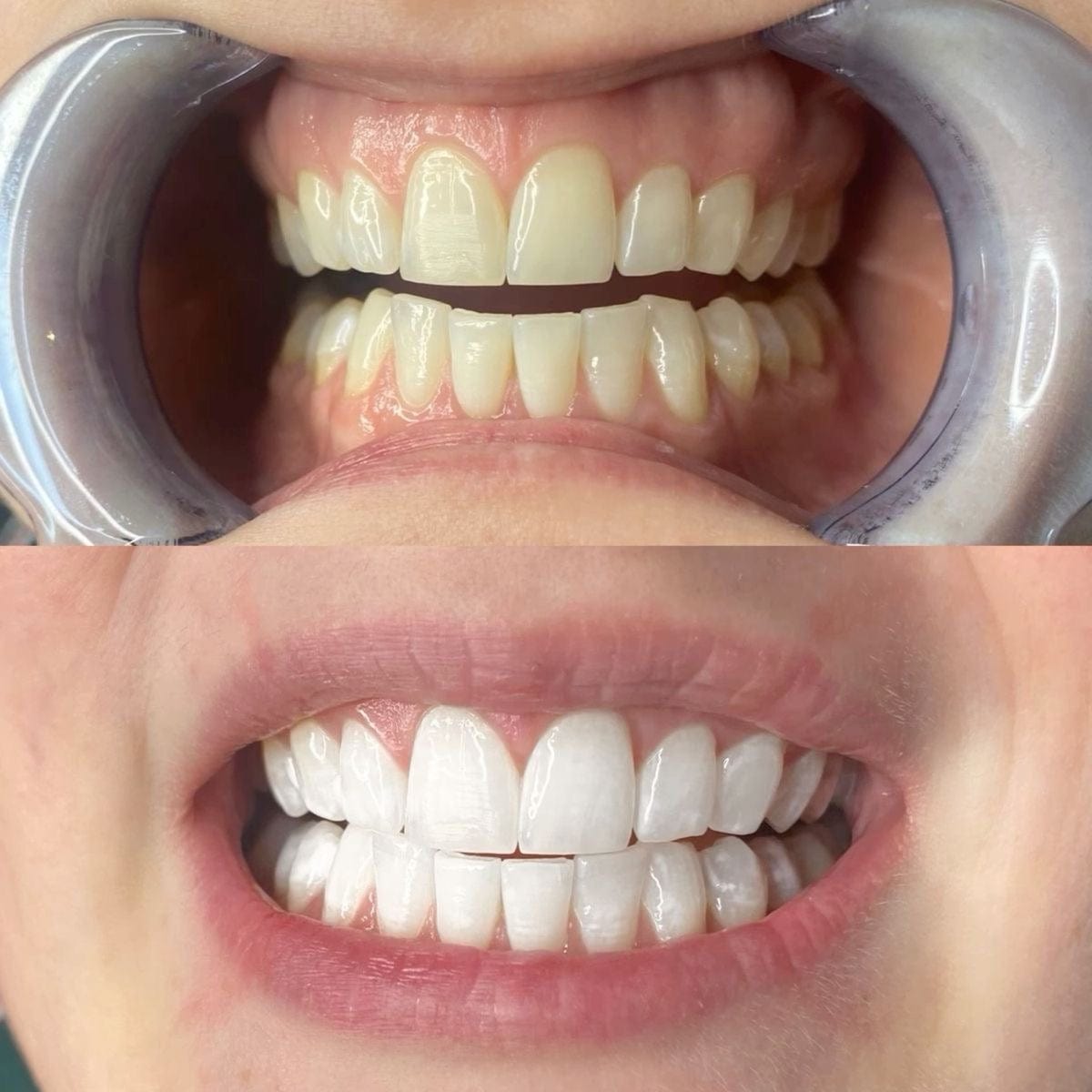 CREST 3D WHITESTRIPS™ VIVID WHITE