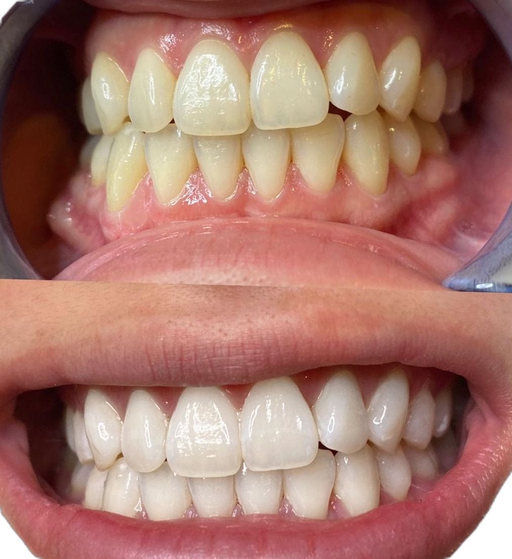 CREST 3D WHITESTRIPS™ BRIGHT WHITE